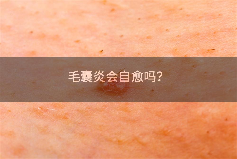 毛囊炎会自愈吗？
