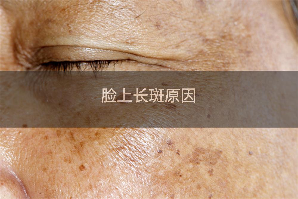 脸上长斑原因