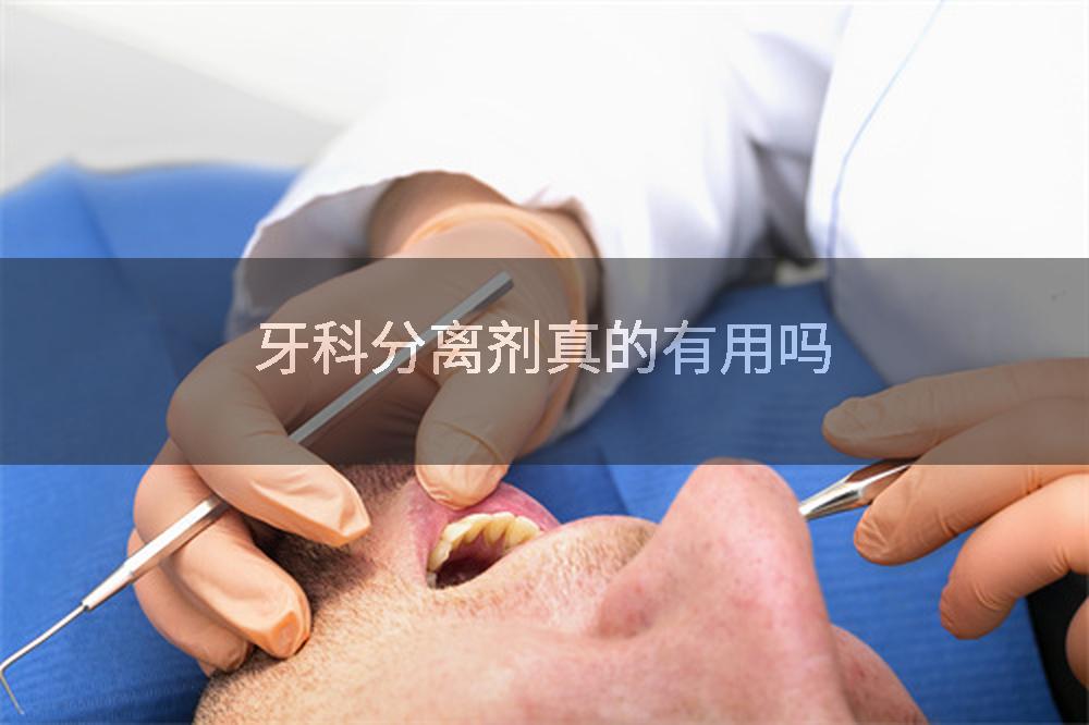 牙科分离剂真的有用吗