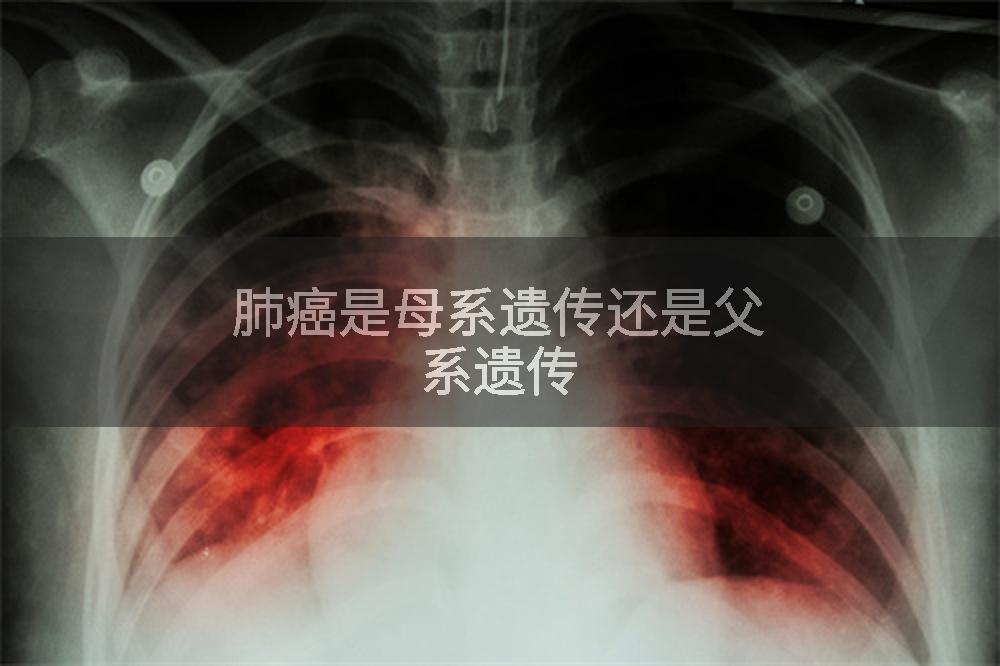 肺癌是母系遗传还是父系遗传