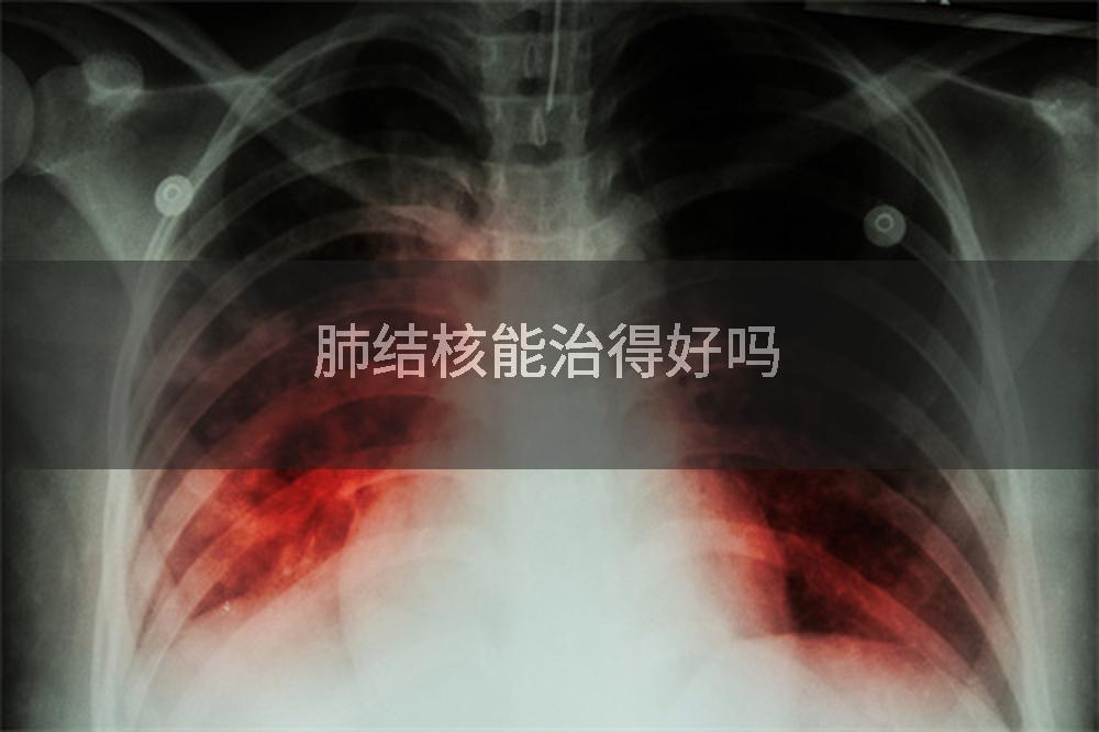 肺结核能治得好吗