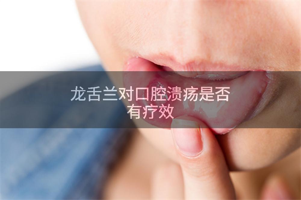 龙舌兰对口腔溃疡是否有疗效