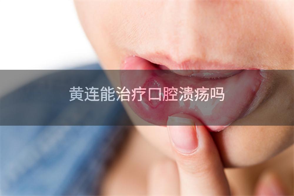 黄连能治疗口腔溃疡吗