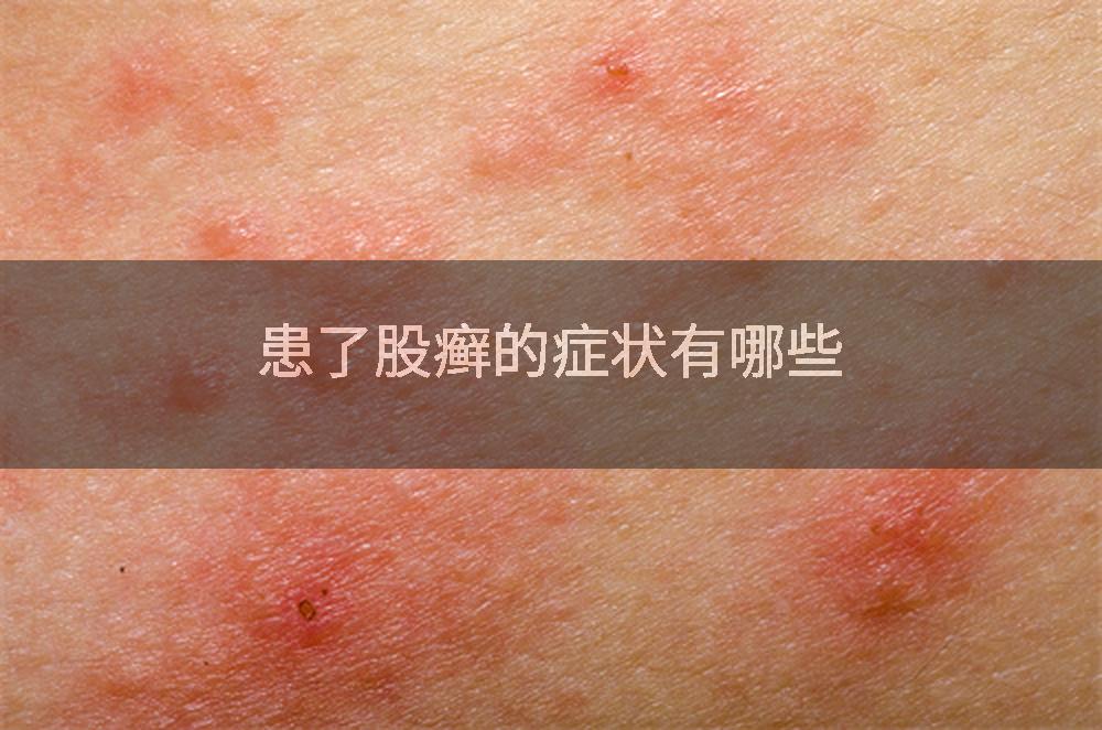 患了股癣的症状有哪些