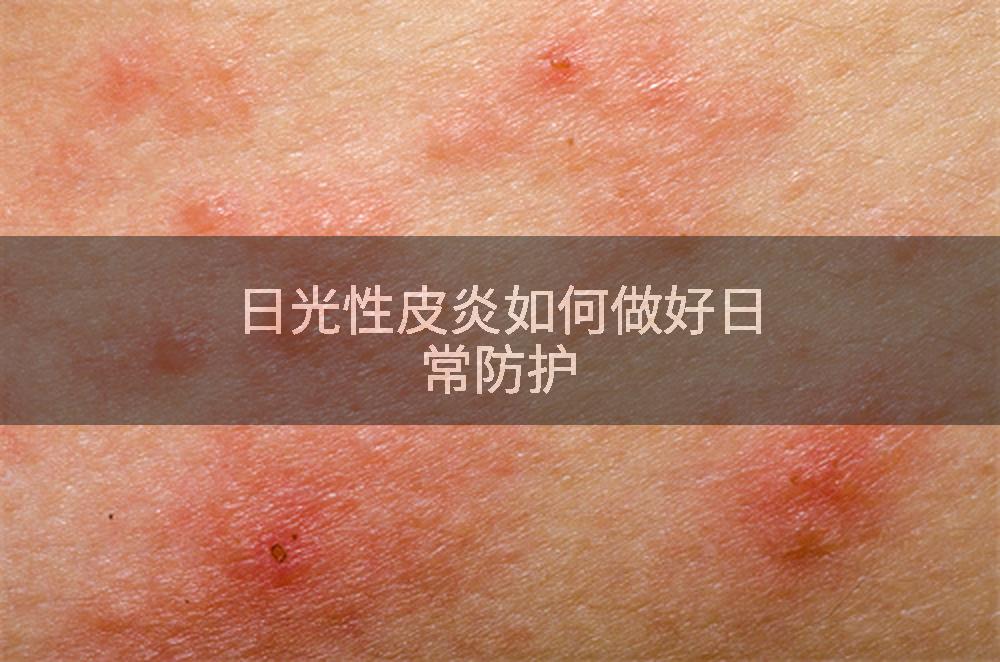 日光性皮炎如何做好日常防护