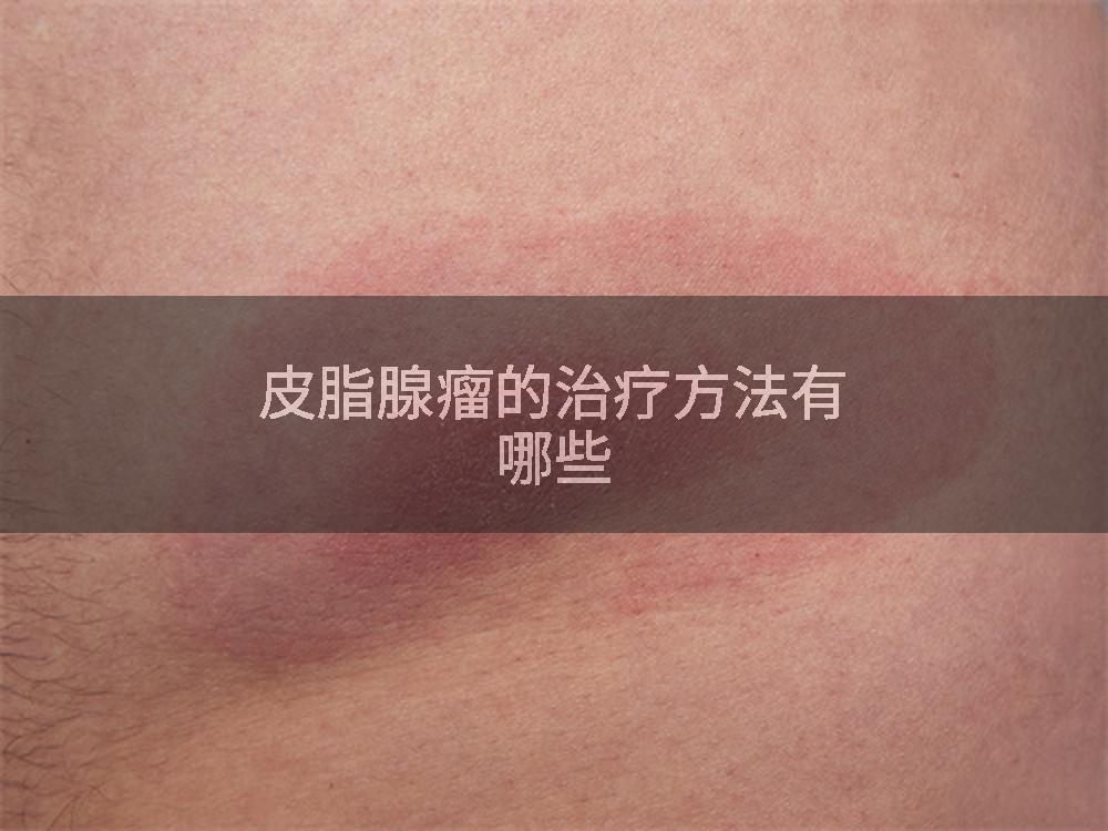 皮脂腺瘤的治疗方法有哪些