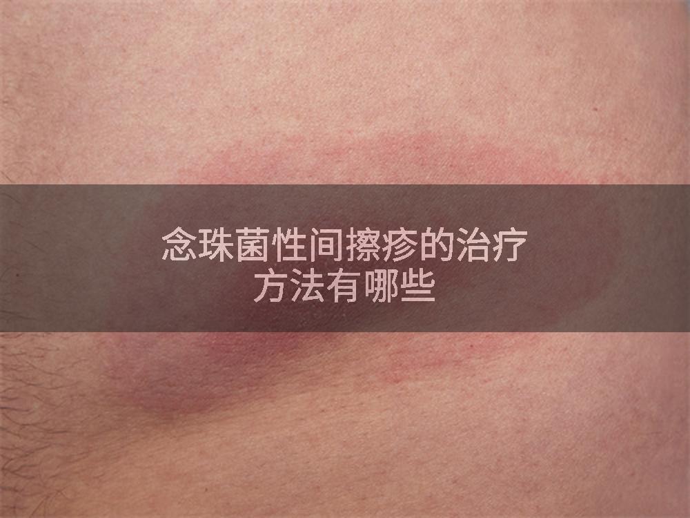 念珠菌性间擦疹的治疗方法有哪些