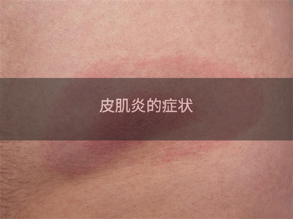 皮肌炎的症状