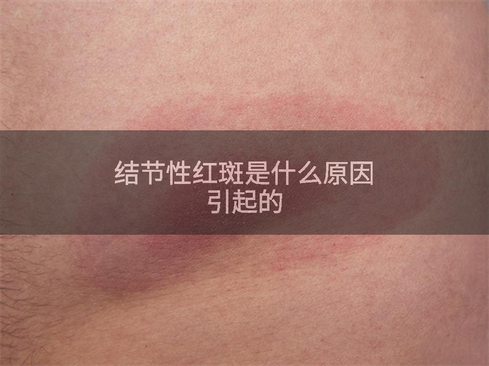 结节性红斑是什么原因引起的
