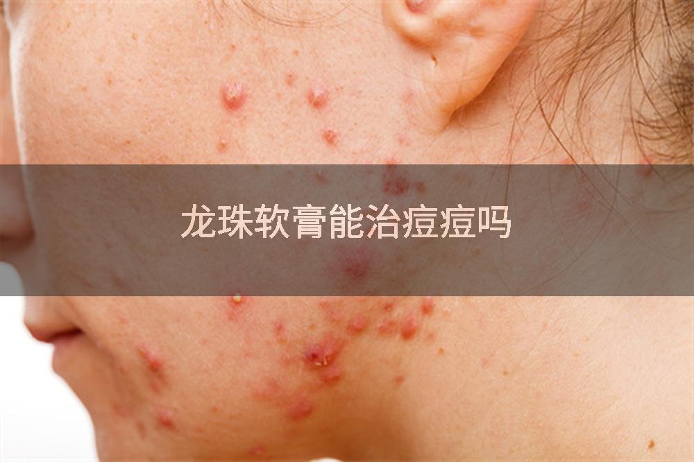 龙珠软膏能治痘痘吗