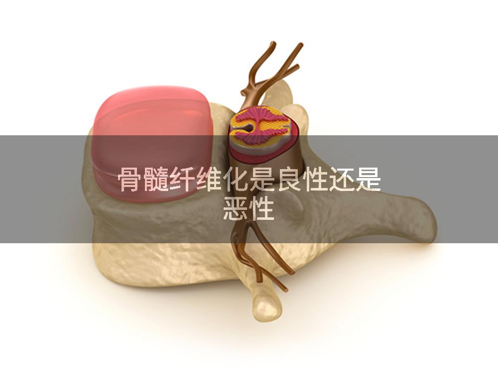 骨髓纤维化是良性还是恶性