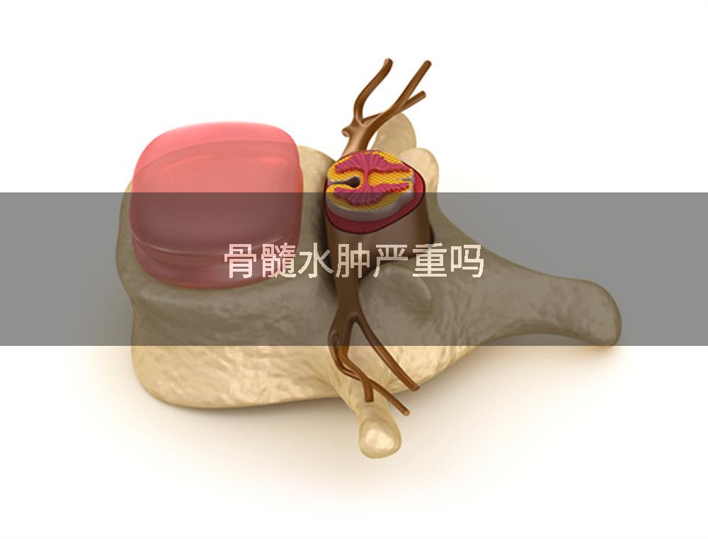 骨髓水肿严重吗