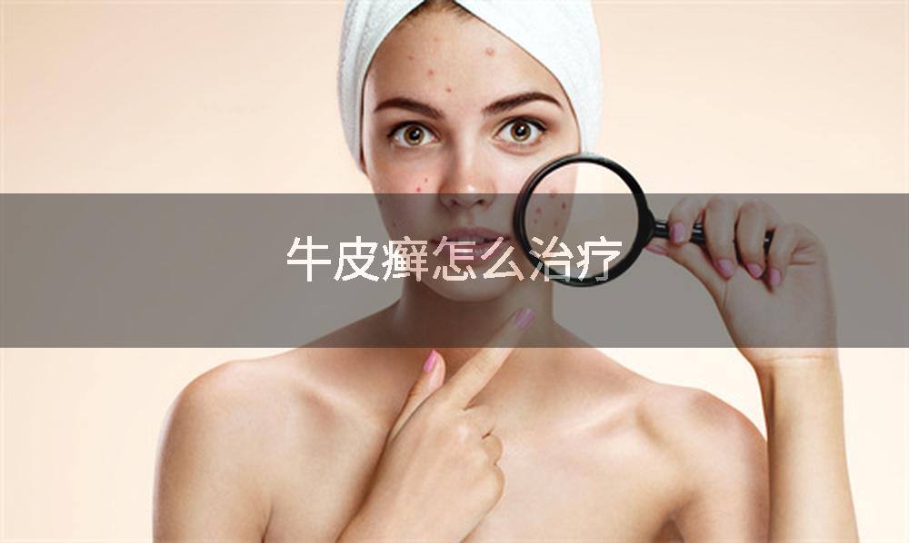 牛皮癣怎么治疗