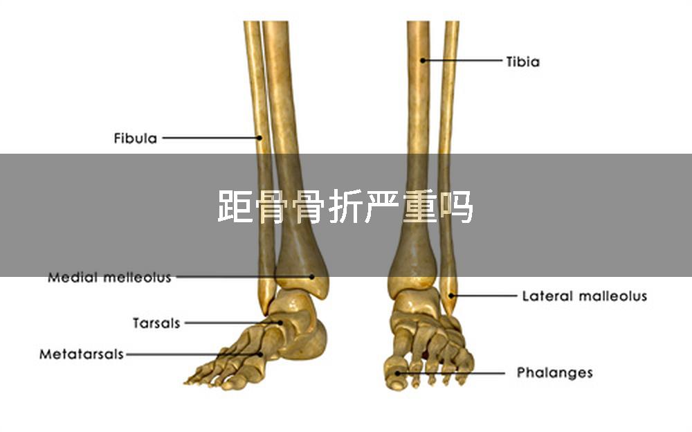距骨骨折严重吗