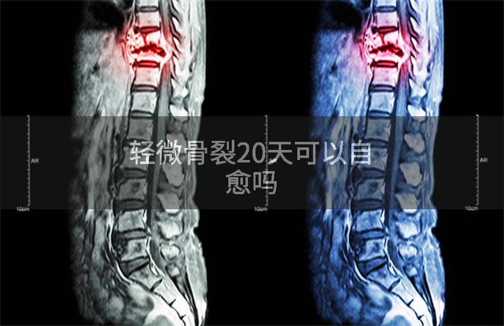 轻微骨裂20天可以自愈吗