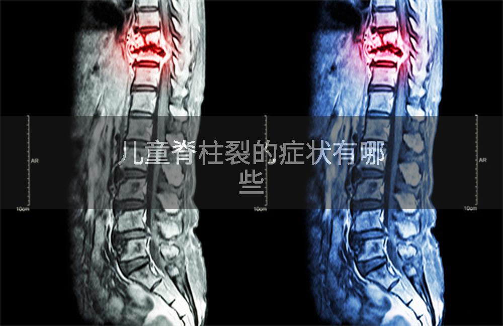 儿童脊柱裂的症状有哪些