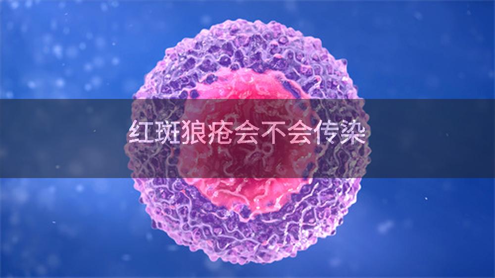 红斑狼疮会不会传染