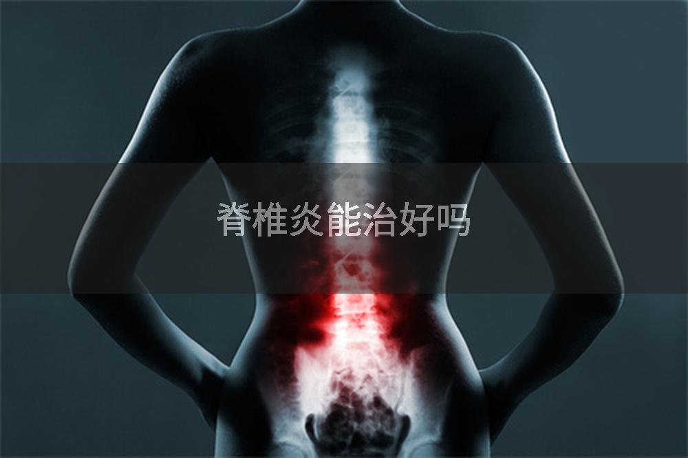 脊椎炎能治好吗