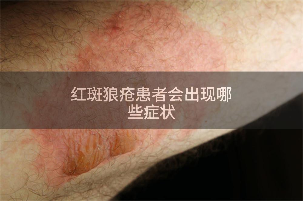 红斑狼疮患者会出现哪些症状