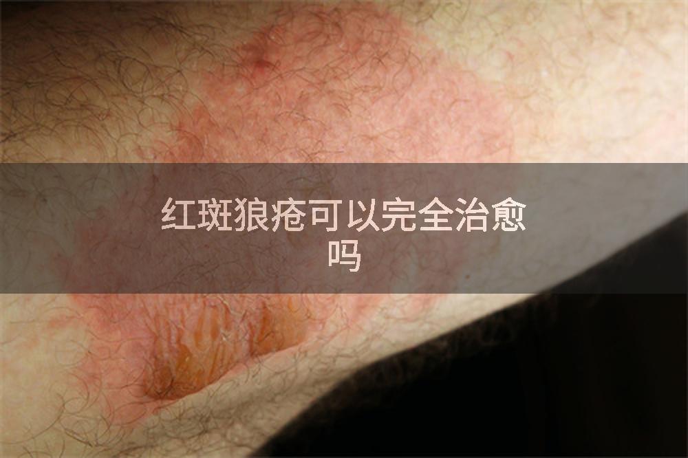 红斑狼疮可以完全治愈吗