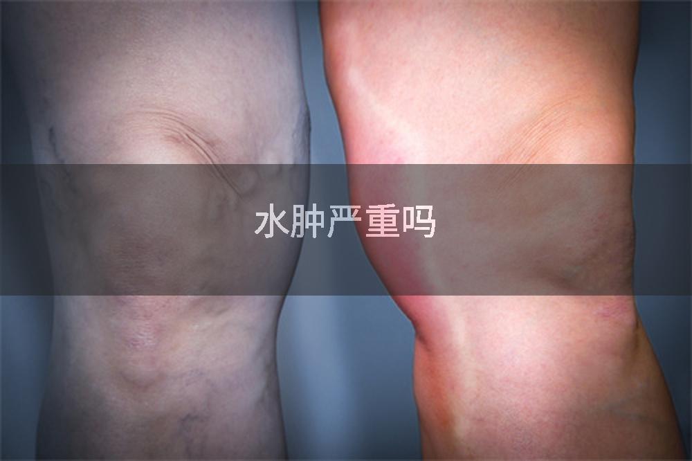水肿严重吗