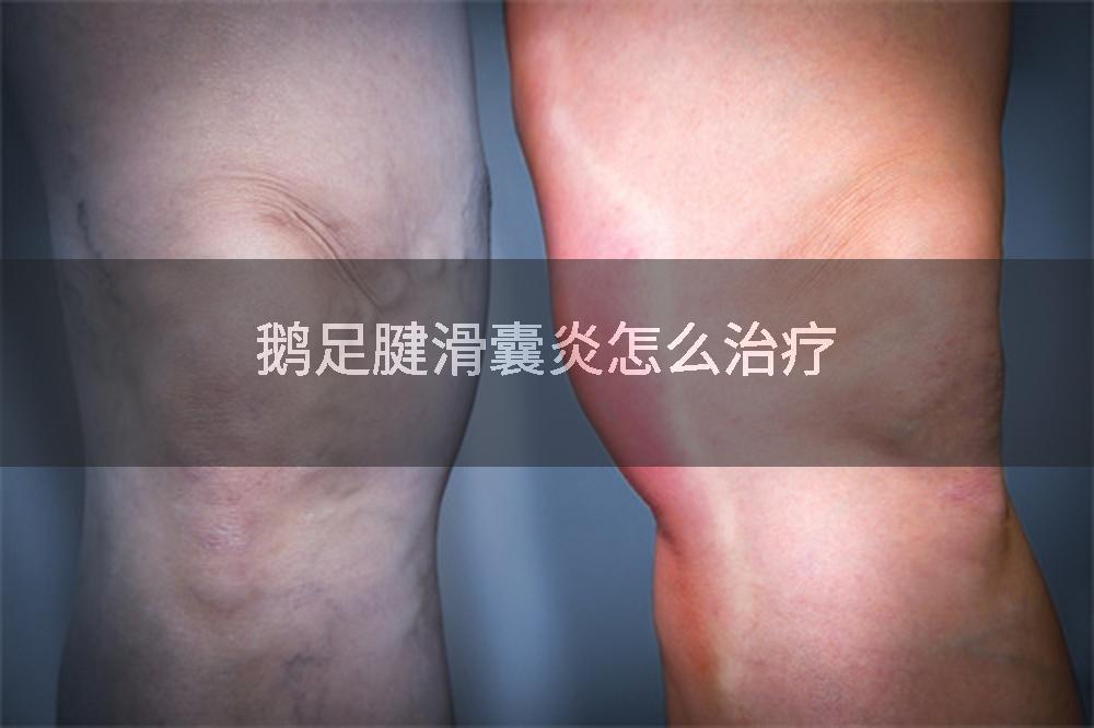 鹅足腱滑囊炎怎么治疗