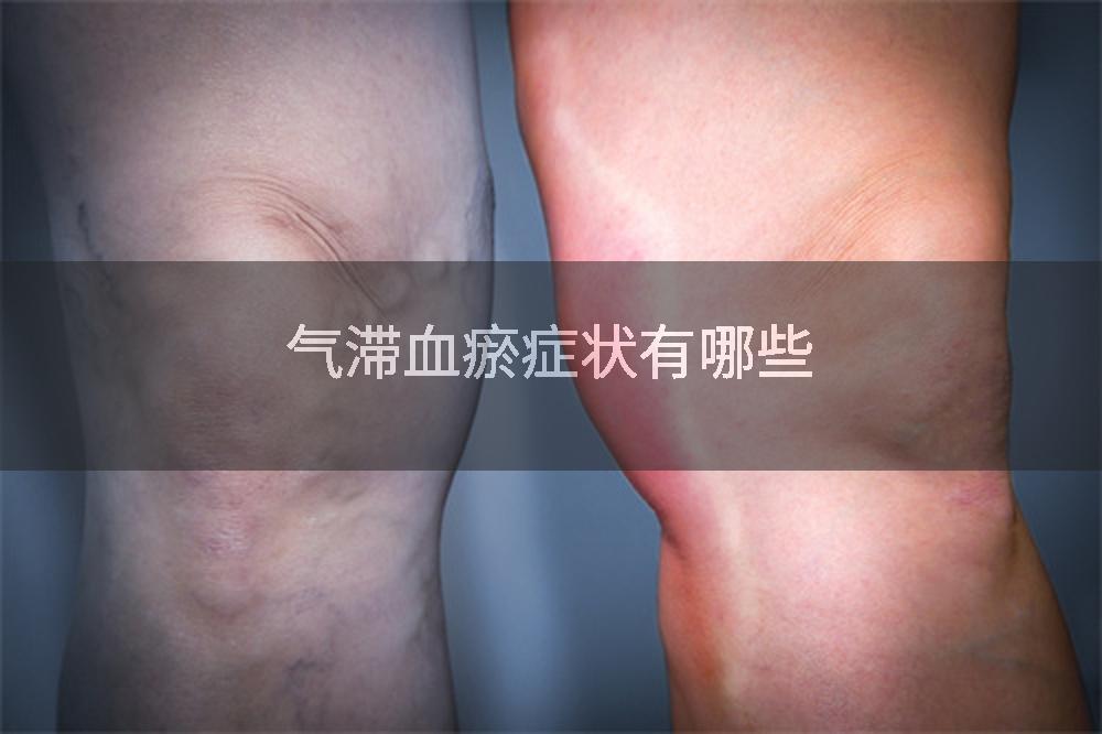 气滞血瘀症状有哪些