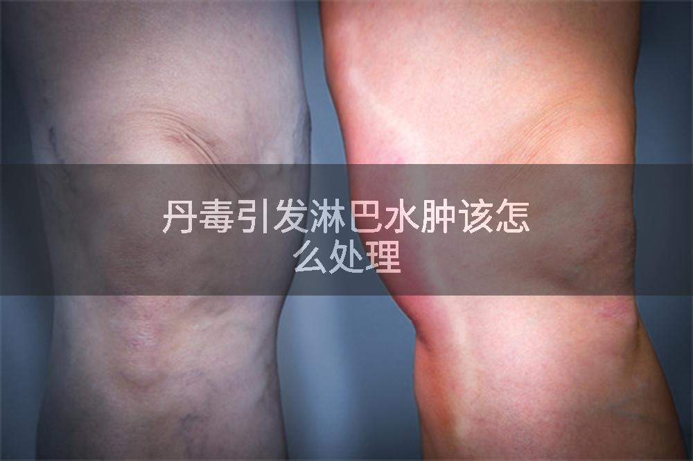 丹毒引发淋巴水肿该怎么处理