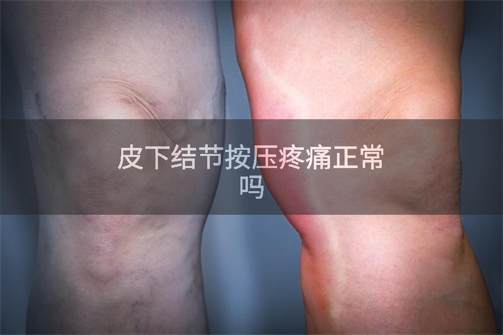 皮下结节按压疼痛正常吗