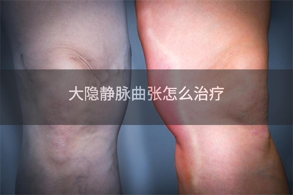 大隐静脉曲张怎么治疗
