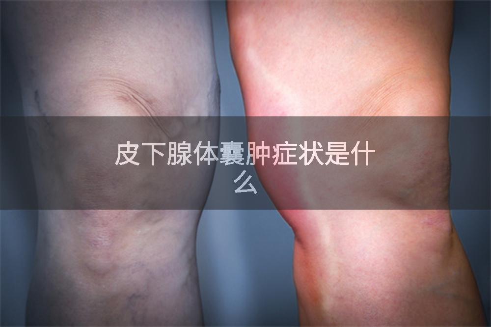 皮下腺体囊肿症状是什么