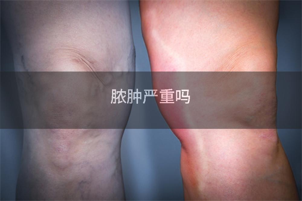脓肿严重吗