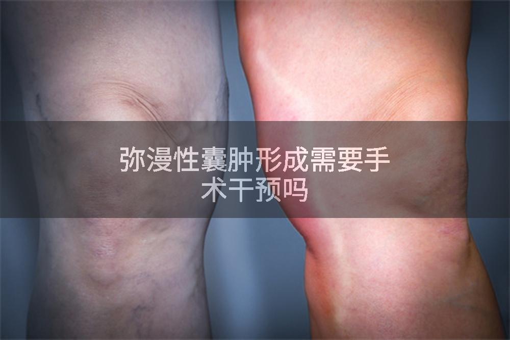 弥漫性囊肿形成需要手术干预吗