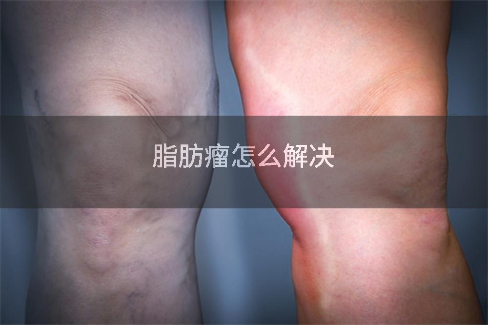 脂肪瘤怎么解决