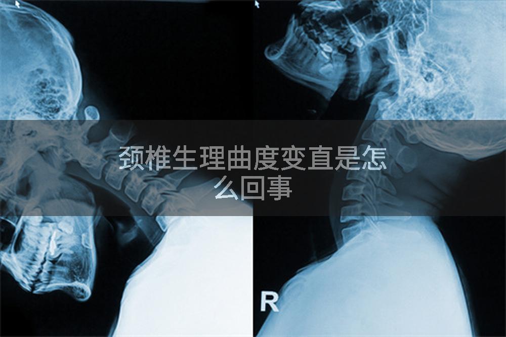 颈椎生理曲度变直是怎么回事