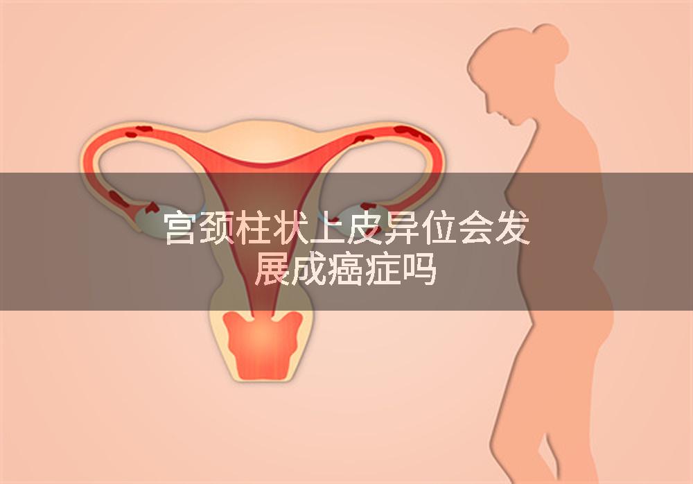 宫颈柱状上皮异位会发展成癌症吗