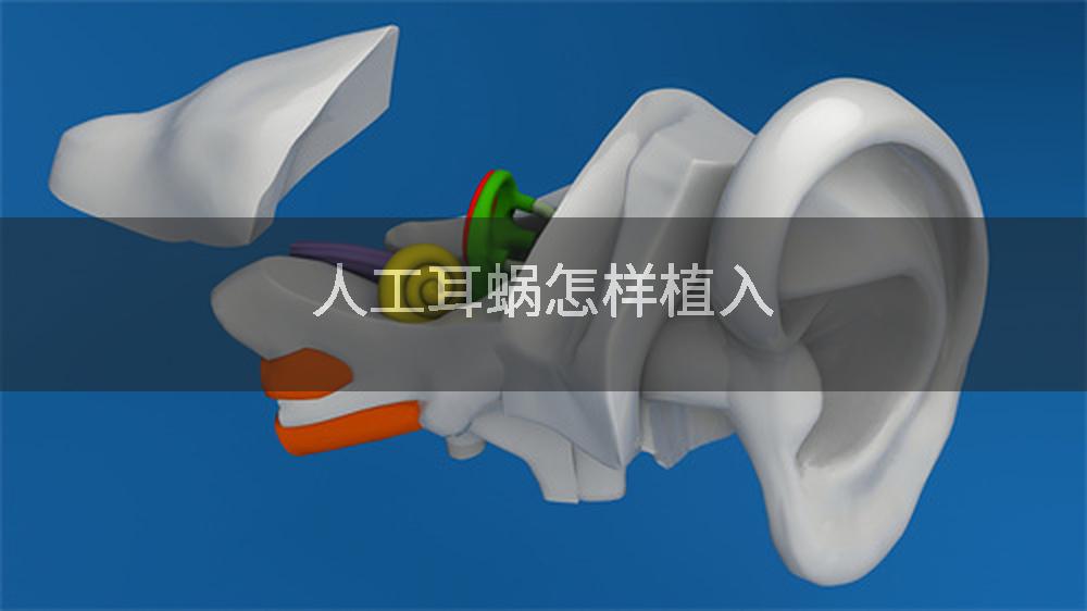 人工耳蜗怎样植入