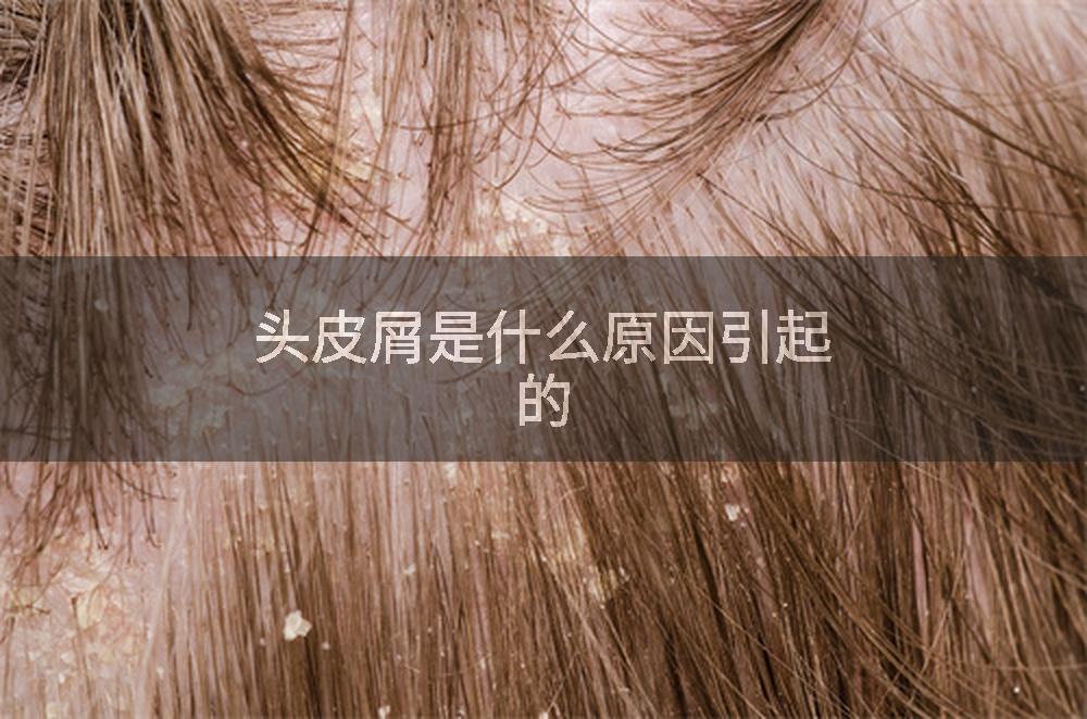 头皮屑是什么原因引起的