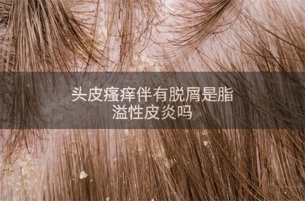 头皮瘙痒伴有脱屑是脂溢性皮炎吗