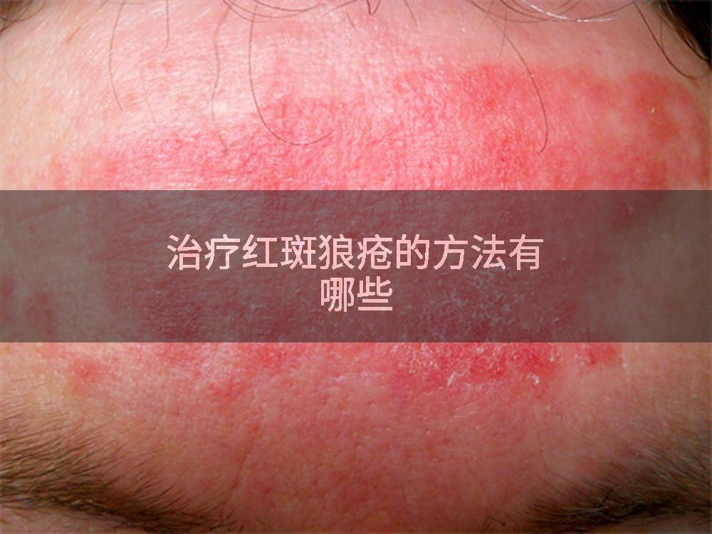 治疗红斑狼疮的方法有哪些