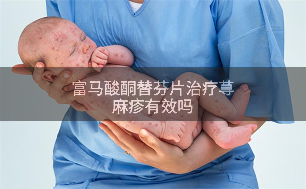 富马酸酮替芬片治疗荨麻疹有效吗