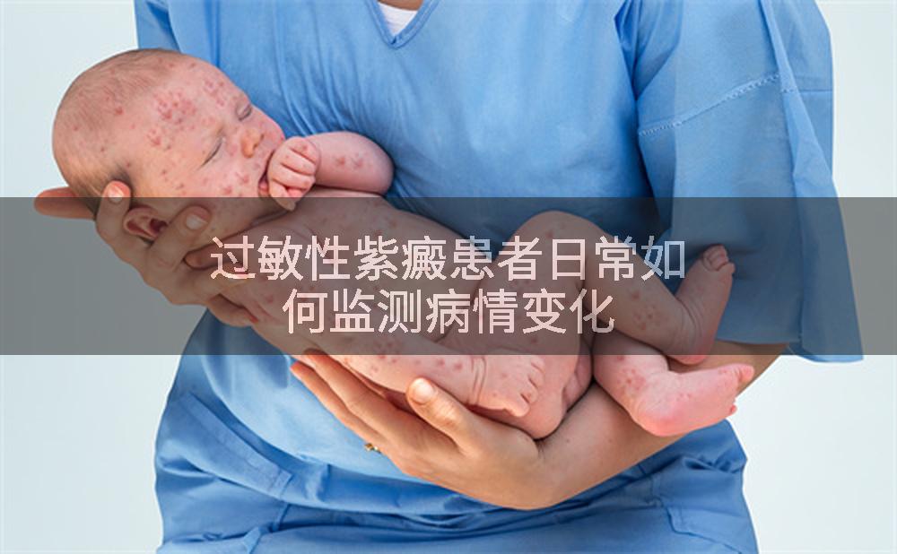 过敏性紫癜患者日常如何监测病情变化