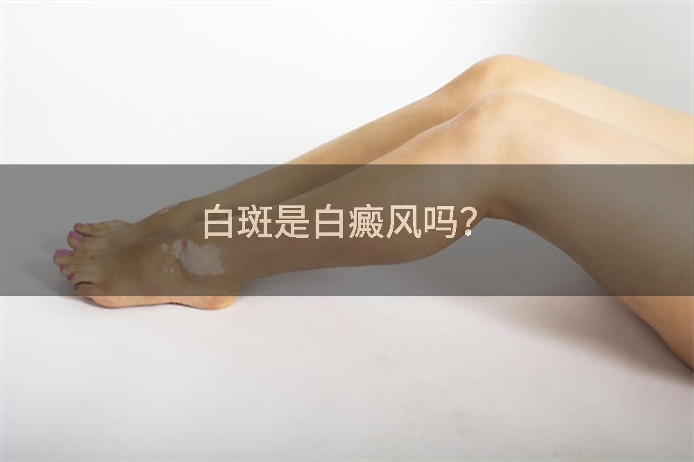 白斑是白癜风吗？
