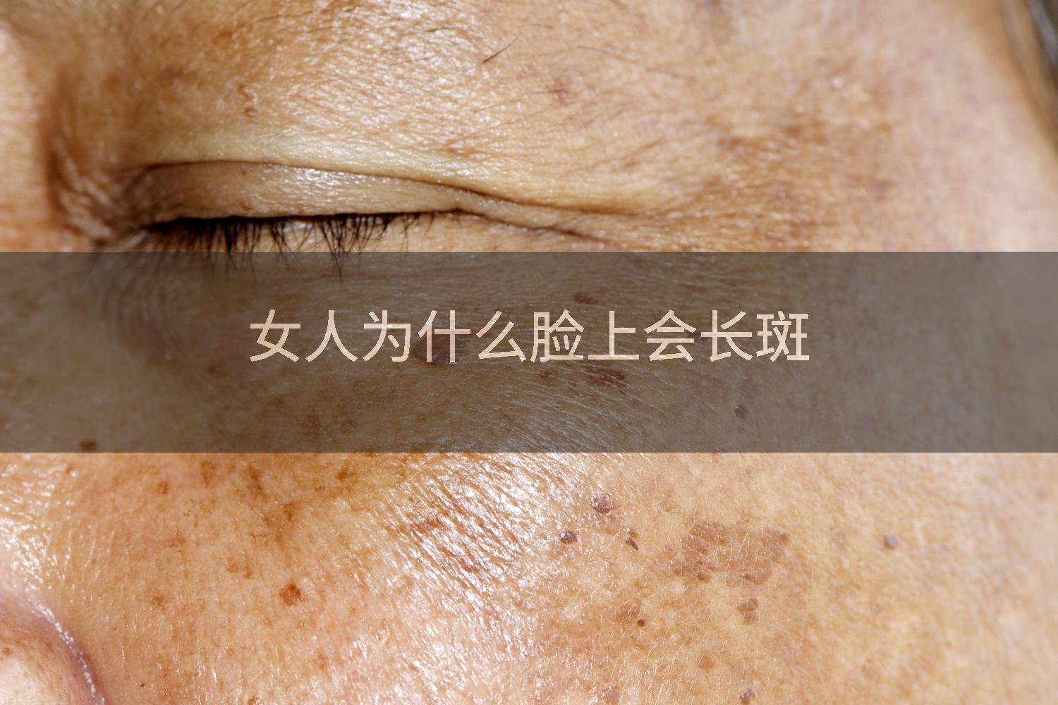 女人为什么脸上会长斑