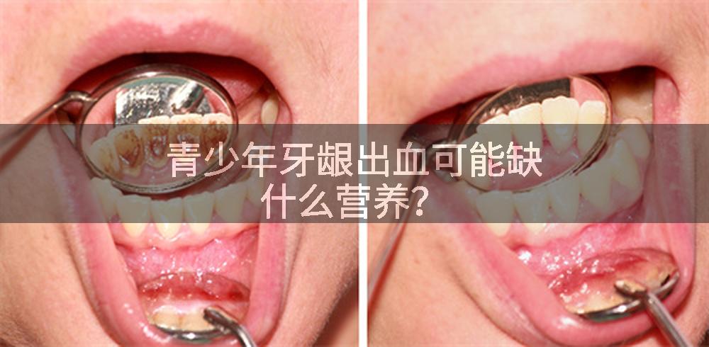 青少年牙龈出血可能缺什么营养？