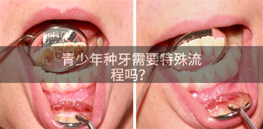 青少年种牙需要特殊流程吗？