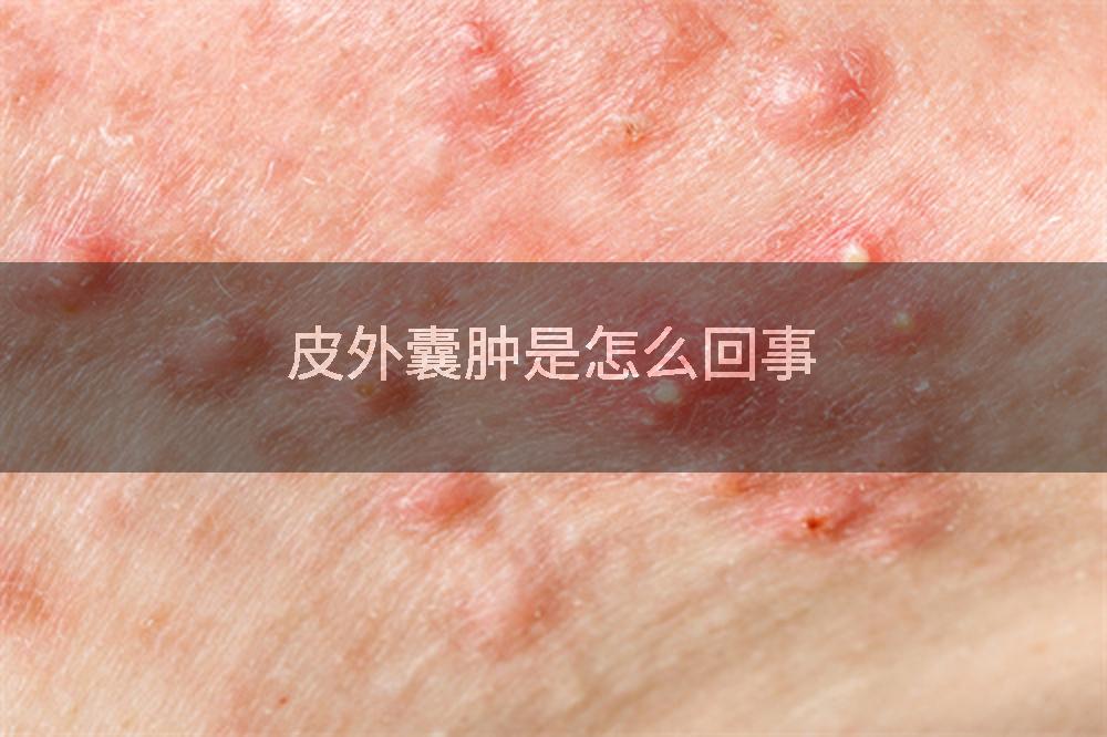 皮外囊肿是怎么回事