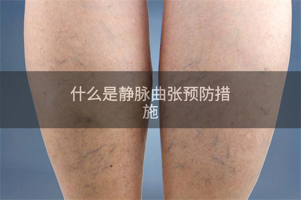 什么是静脉曲张预防措施