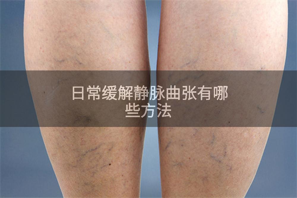 日常缓解静脉曲张有哪些方法