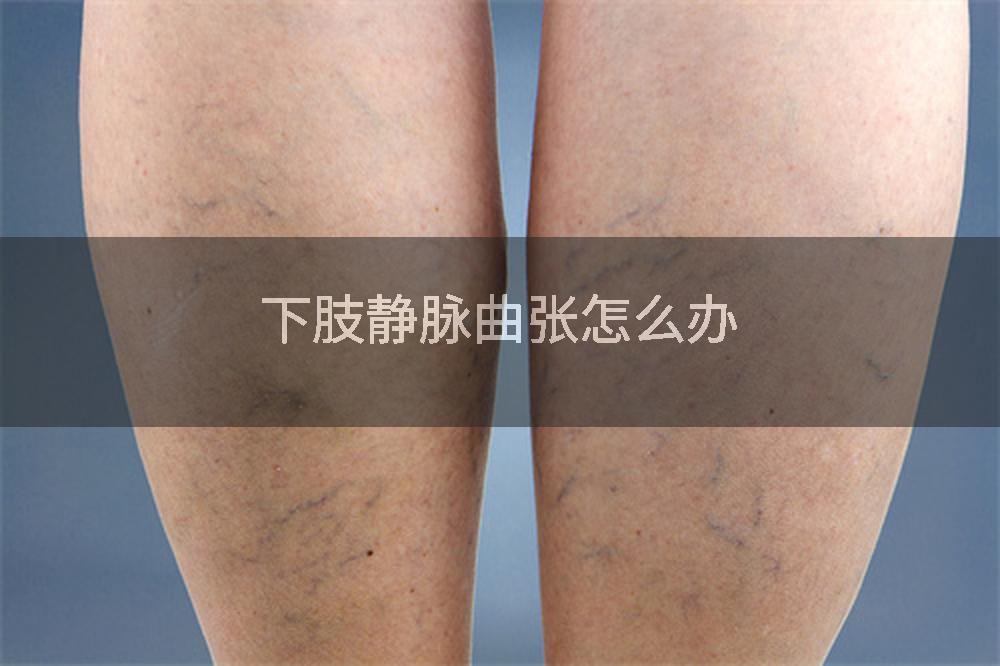 下肢静脉曲张怎么办